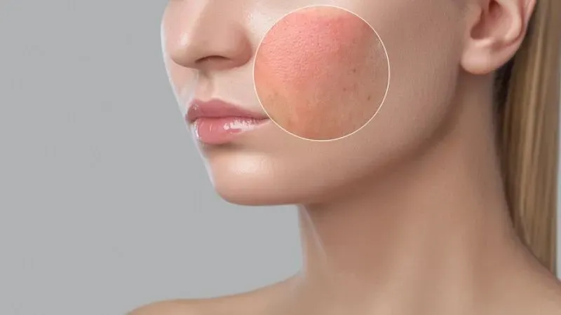 Cách phòng tránh dị ứng mỹ phẩm trên da