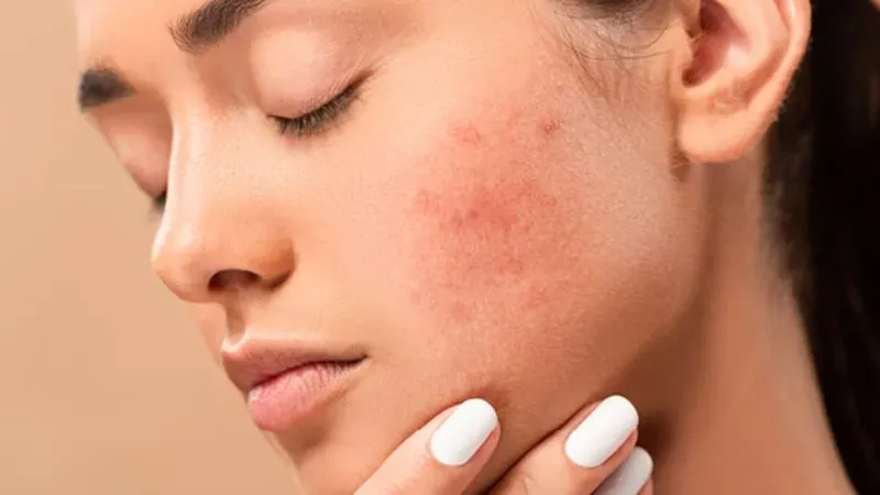 Cách chăm sóc da khi phát hiện bị dị ứng mỹ phẩm