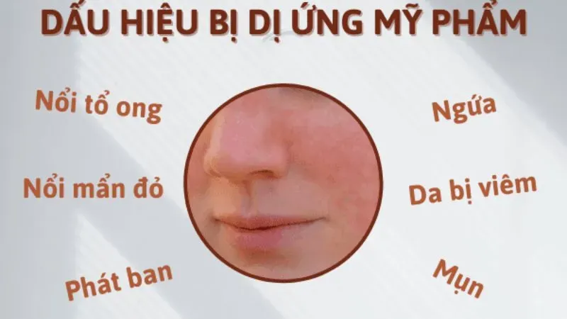 Nhận biết các dấu hiệu dị ứng mỹ phẩm