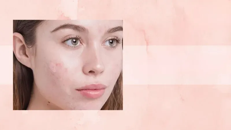 Những lưu ý khi chăm sóc da mụn