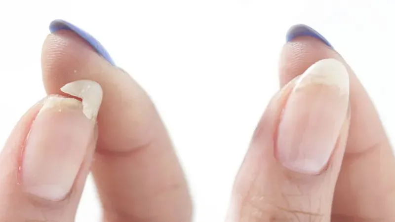 Nguyên nhân dẫn đến móng tay yếu và dễ gãy