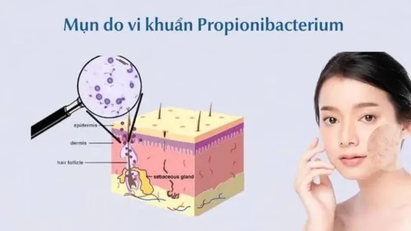 Triệu chứng mụn nội tiết