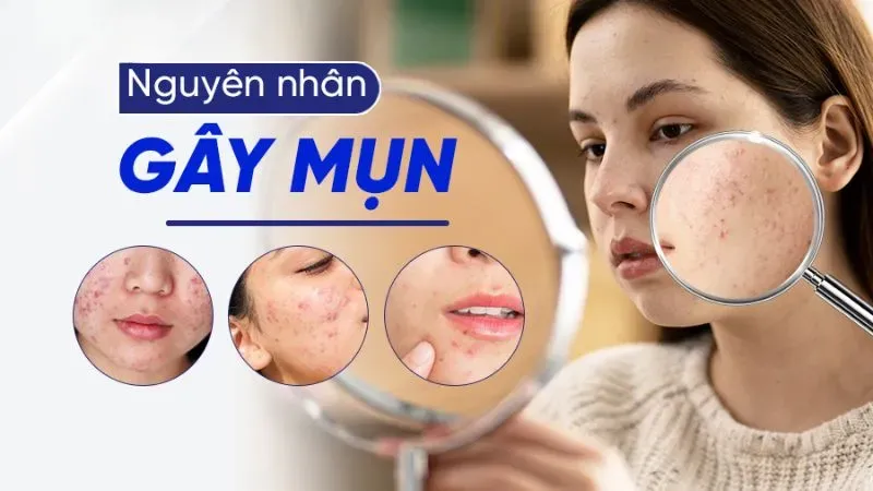 Nguyên nhân gây ra mụn nội tiết