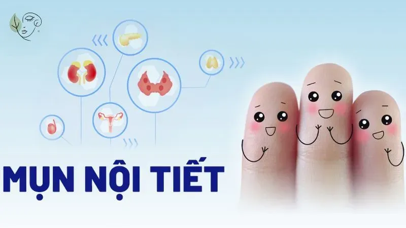 Mụn nội tiết tố là gì?