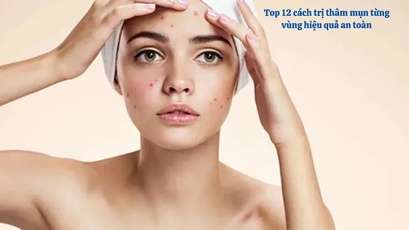 Top 12 cách trị thâm mụn từng vùng hiệu quả an toàn