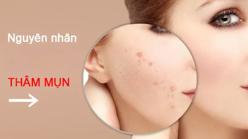 Nguyên nhân gây thâm mụn