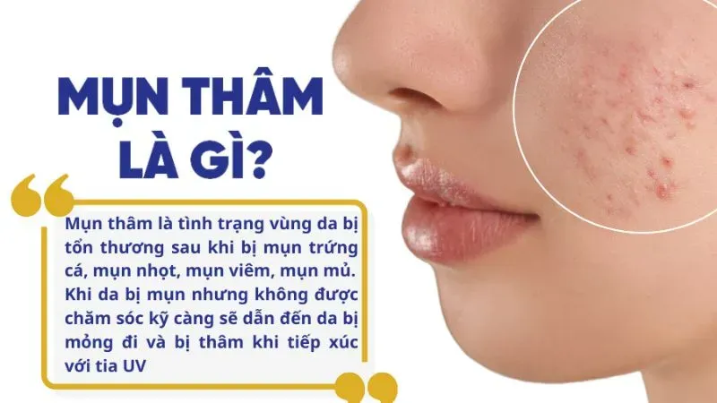 Mụn thâm là gì? Phân loại mụn thâm