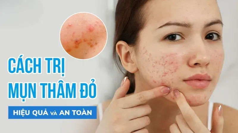 Top 12 cách trị thâm mụn từng vùng hiệu quả an toàn