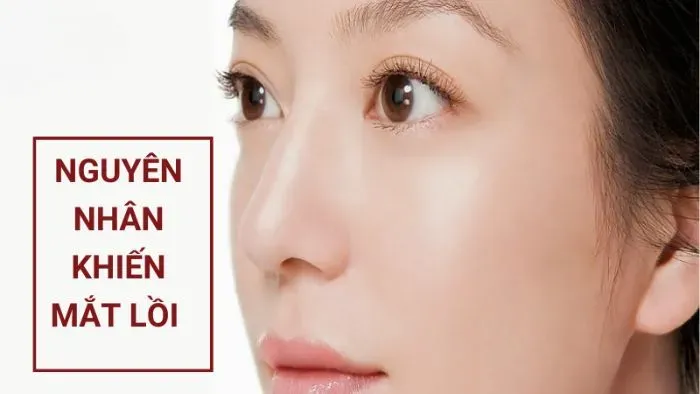 Nguyên nhân khiến mắt lồi