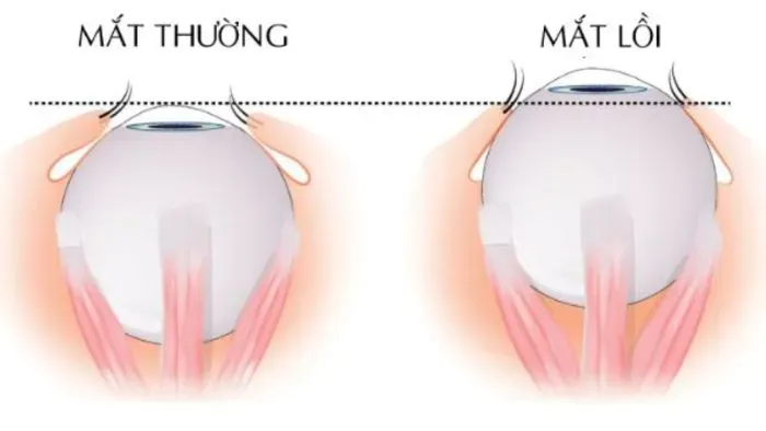Mắt bị lồi là gì?
