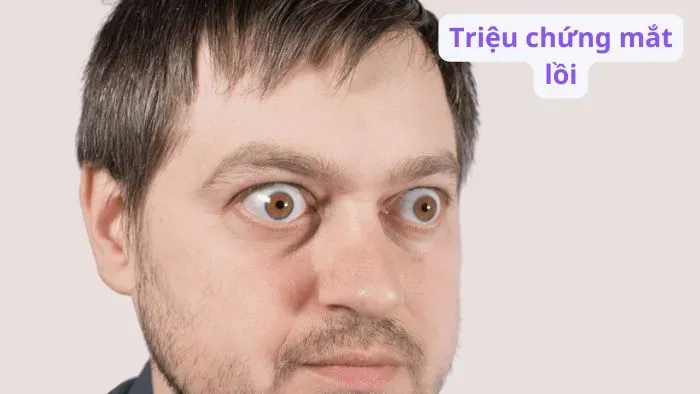 Triệu chứng mắt lồi