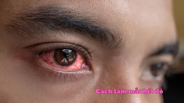 Cách làm mắt hết đỏ