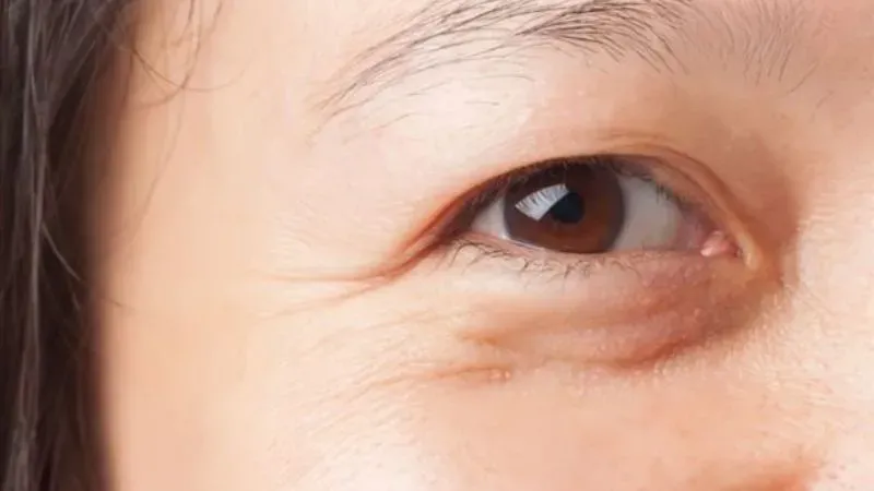 Dấu hiệu nhận biết nếp nhăn dưới mắt