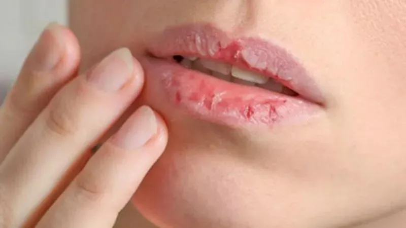 Lưu ý khi dưỡng môi