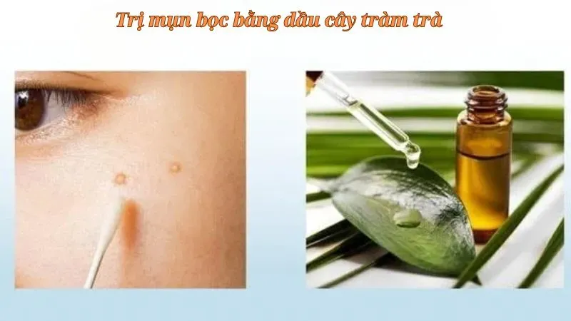Dầu cây tràm trà