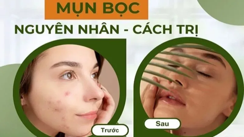 Tại sao mụn bọc lại xuất hiện?