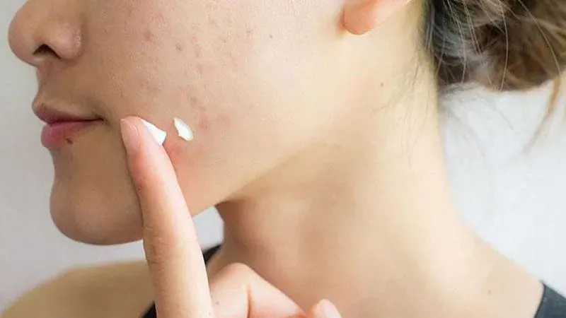 Cách chăm sóc da mặt sau khi tự trị mụn bọc tại nhà