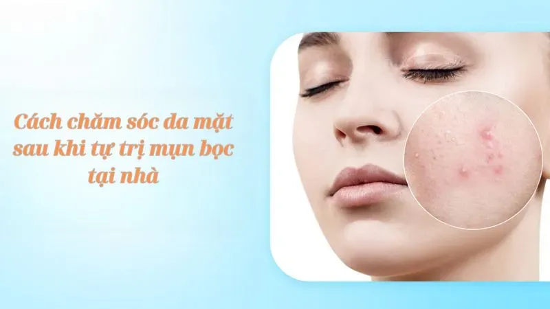 Cách chăm sóc da mặt sau khi tự trị mụn bọc tại nhà