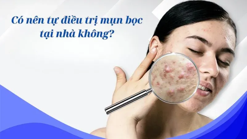 Có nên tự điều trị mụn bọc tại nhà không?