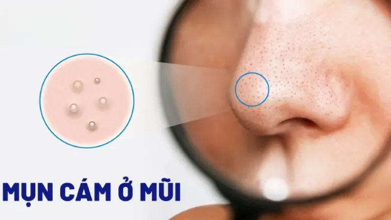 4 cách trị mụn cám hiệu quả