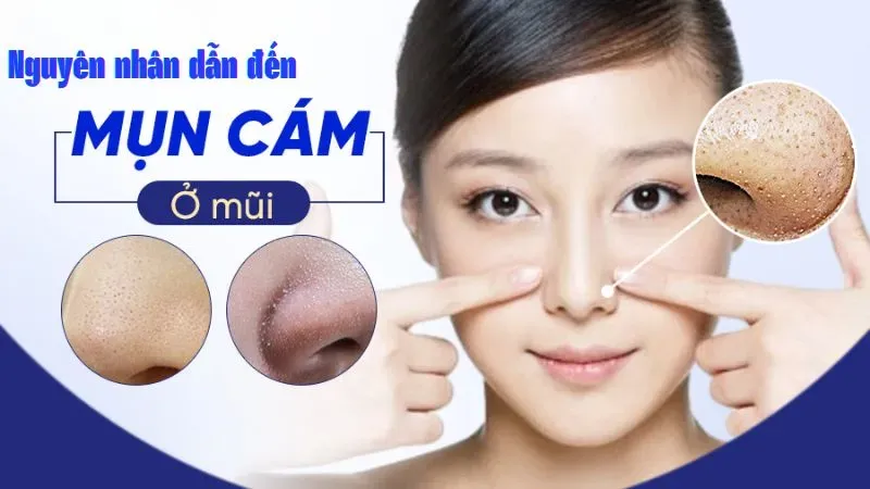 Nguyên nhân dẫn tới tình trạng mụn cám ở mũi