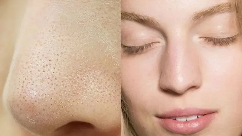 Cách ngăn ngừa mụn cám ở mũi