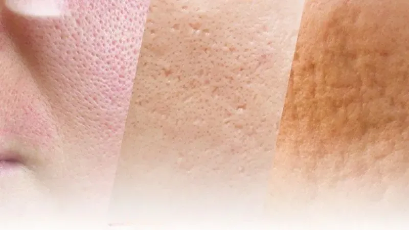 Mẹo ngăn ngừa sẹo rỗ sâu và nặng