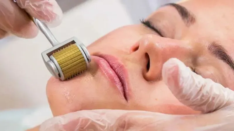 7 phương pháp trị sẹo rỗ hiện đại và chuyên nghiệp