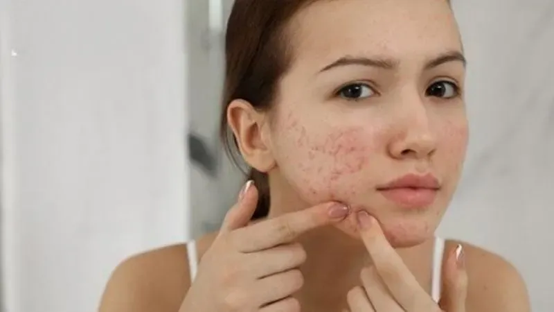 Lưu ý khi chọn dầu tẩy trang cho da mụn