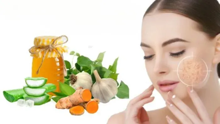 Nám da có chữa được không?