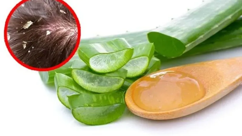 Cách làm sạch da đầu bị ngứa và gàu