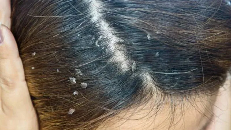 Cách làm sạch da đầu bị ngứa và gàu