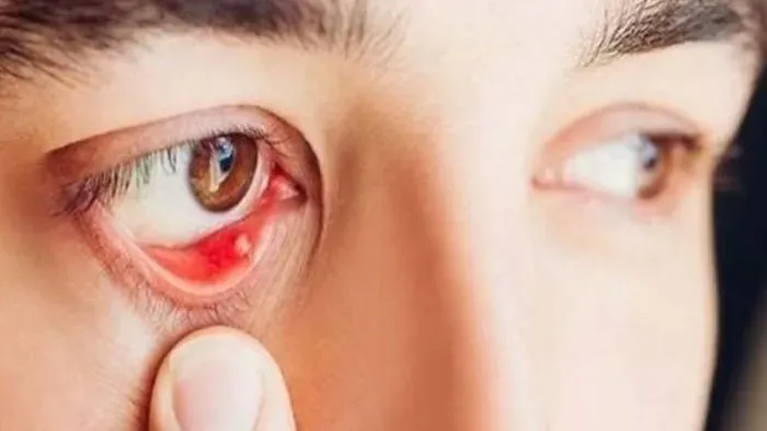 Biện pháp phòng ngừa mụn trắng ở mắt 