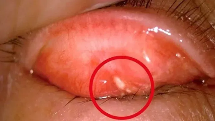 Một số triệu chứng khi mí mắt nổi mụn trắng nhỏ