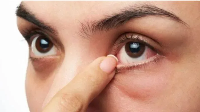 Cách phòng ngừa và hạn chế tình trạng ngứa mi mắt