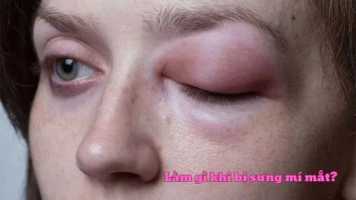 Phòng ngừa tình trạng sưng mí mắt