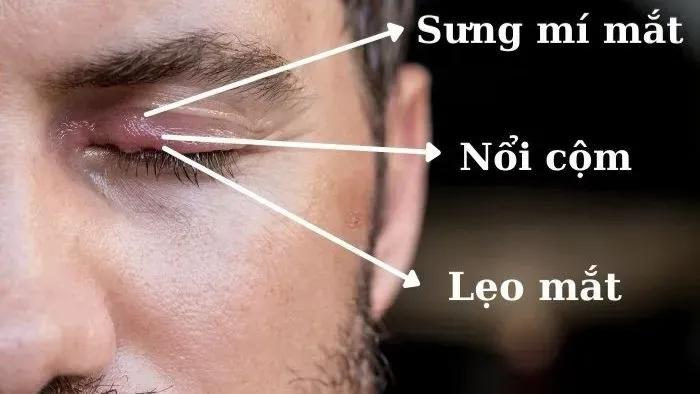 Triệu chứng của mí mắt bị sưng cộm 