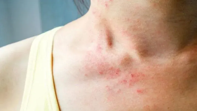 Cách khắc phục mụn ngực hiệu quả