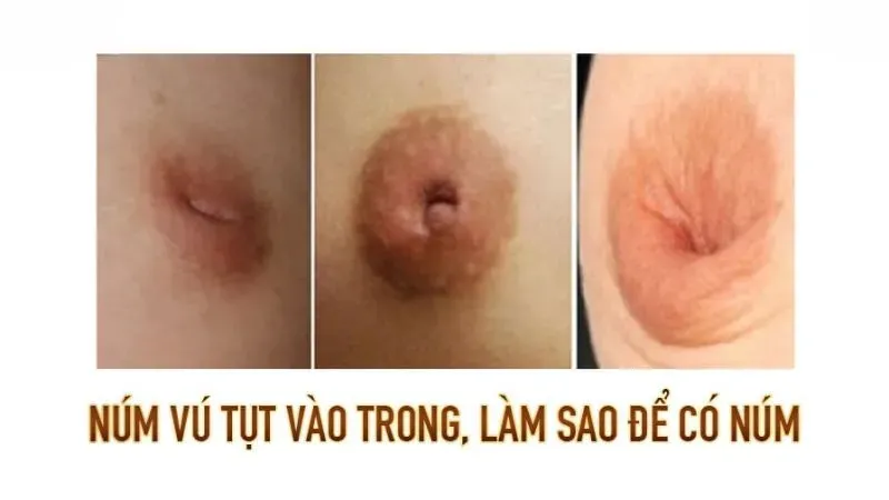 Khái niệm về tình trạng không có núm vú