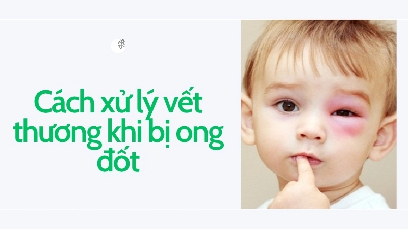 Cách xử lý vết thương khi bị ong đốt