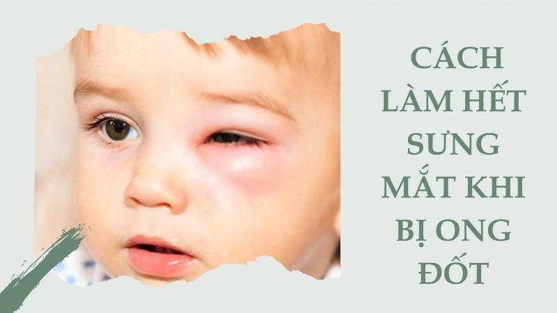 Cách làm hết sưng mắt khi bị ong đốt