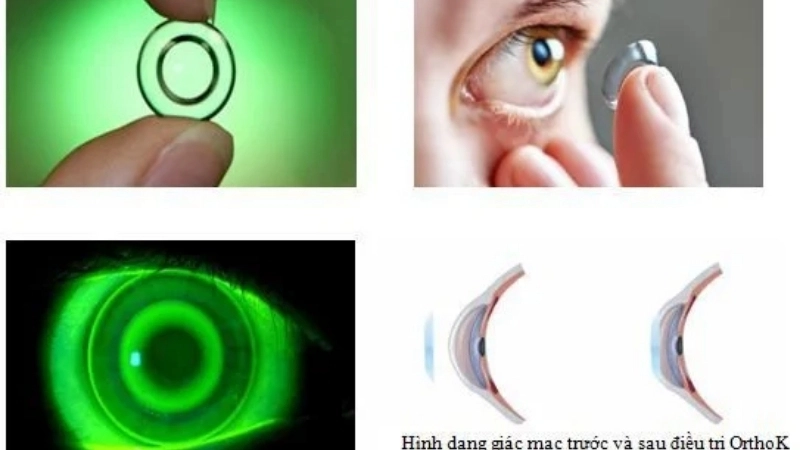 Đeo kính Ortho-K (áp tròng cứng ban đêm)