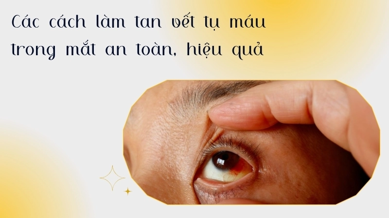 Các cách làm tan vết tụ máu trong mắt an toàn, hiệu quả
