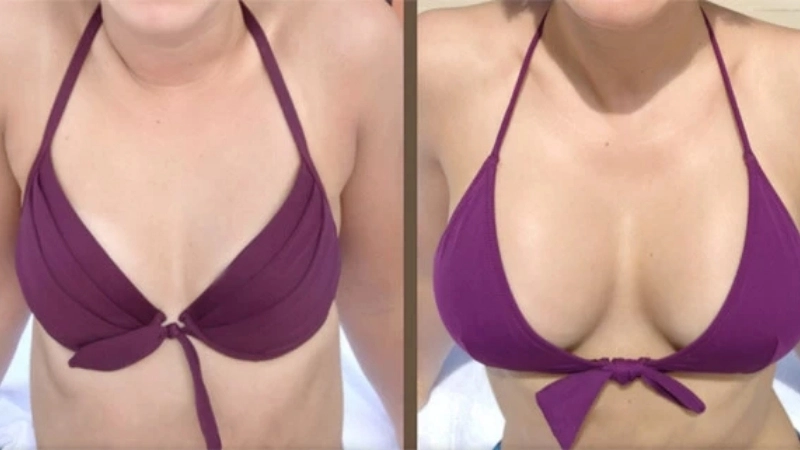 Hỗ trợ quá trình chăm sóc và bảo vệ ngực sau nâng