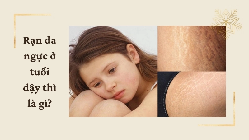 Rạn da ngực ở tuổi dậy thì là gì?