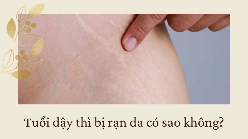 Tuổi dậy thì bị rạn da có sao không?
