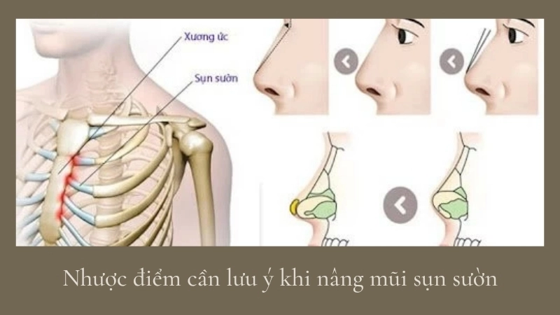 Nhược điểm cần lưu ý khi nâng mũi sụn sườn