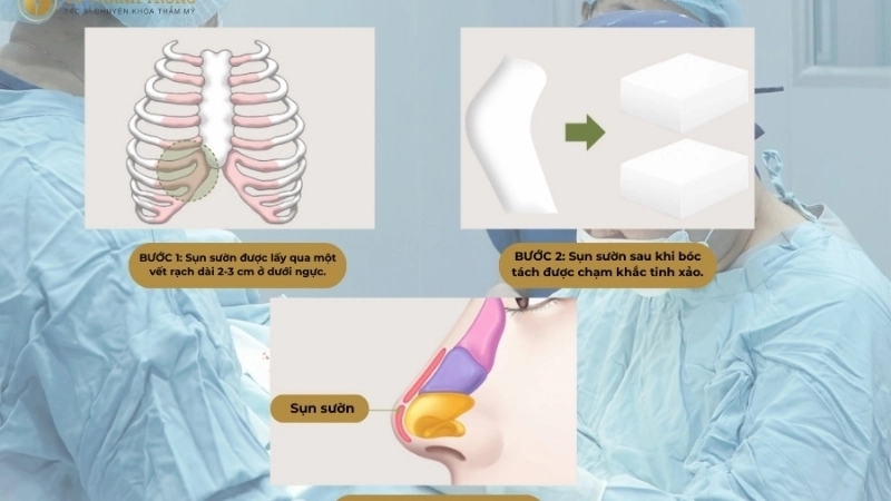 Những lưu ý quan trọng khi nâng mũi sụn sườn