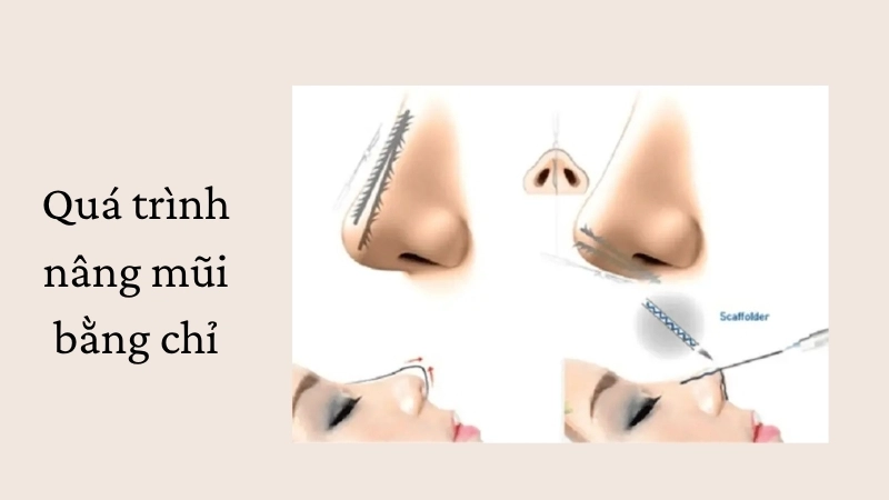 Quá trình nâng mũi bằng chỉ