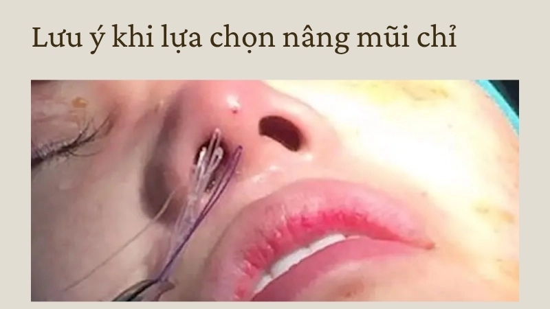 Lưu ý khi lựa chọn nâng mũi chỉ